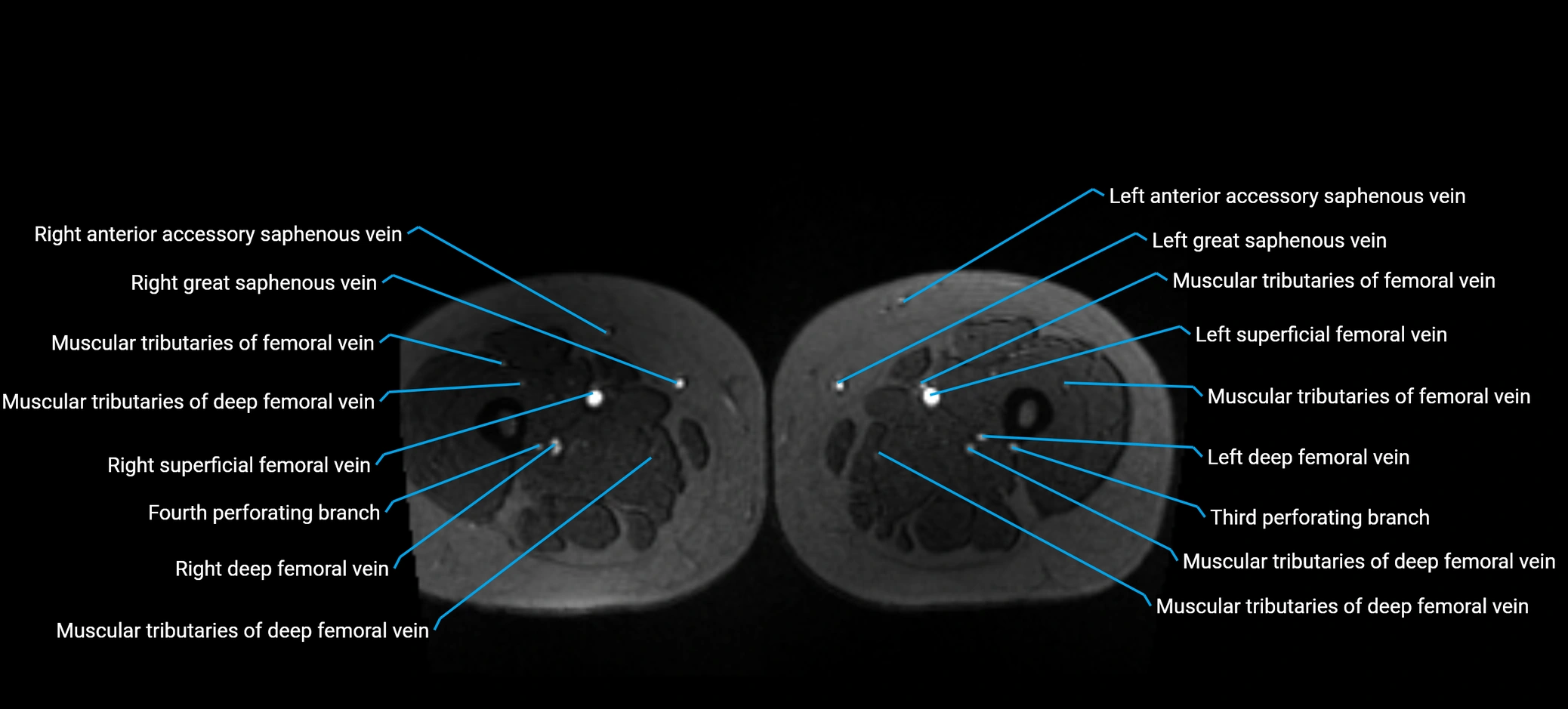 MRV abdomen pelvis & lower limb axial cross sectional anatomy labelled MRI image 254 (1).webp